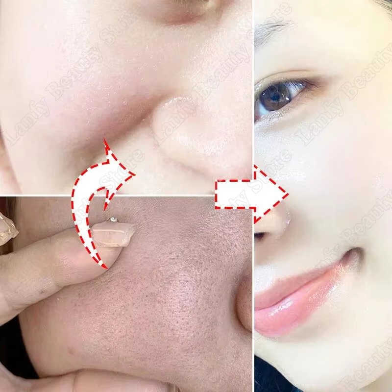 Salicylzuur Poriënreinigende C - Salicylic Acid Blackhead Remover recensie en prijs